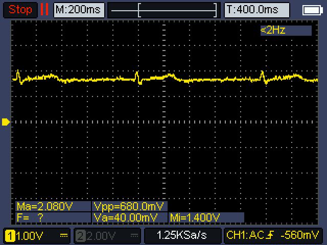 Wykres sygnału EKG z oscyloskopu z pikami zespołu QRS, skala napięcia 1 V/działkę.