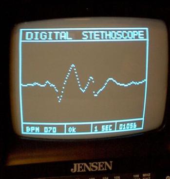 Cyfrowy stetoskop z prezentacją danych na TV