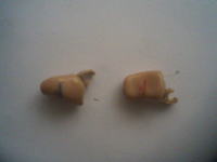 Aparat słuchowy. Mogą z tego być mikrosłuchawki?